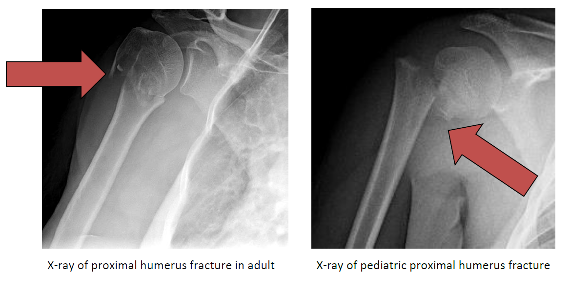 Proximal Humerus Fracture Steven Chudik MD