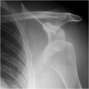 Dislocated shoulder image