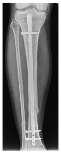 Tibial rod X-ray_9-23-15