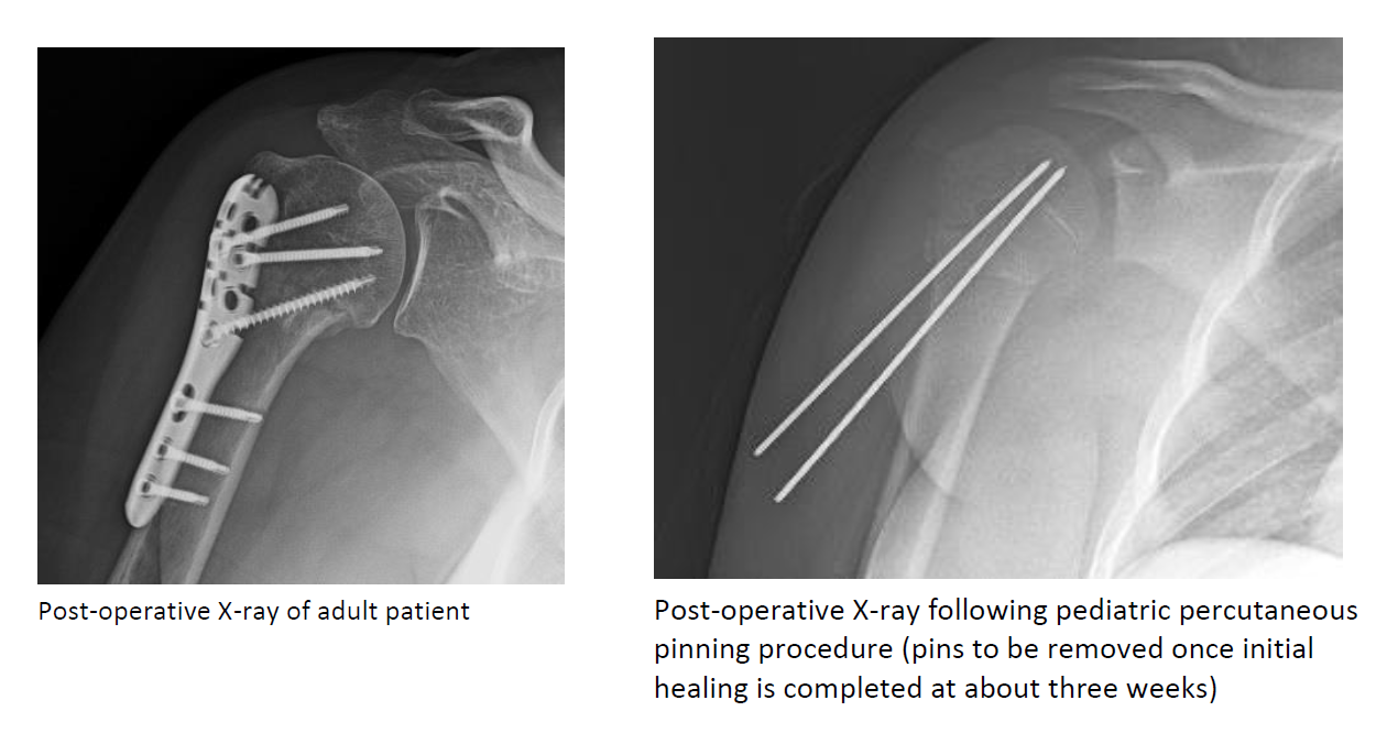 Proximal Humerus Fracture - Steven Chudik MD