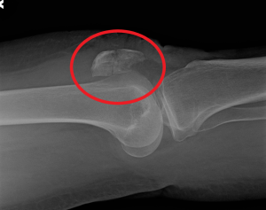 Susan Swanson's repaired patella 3 months post-op