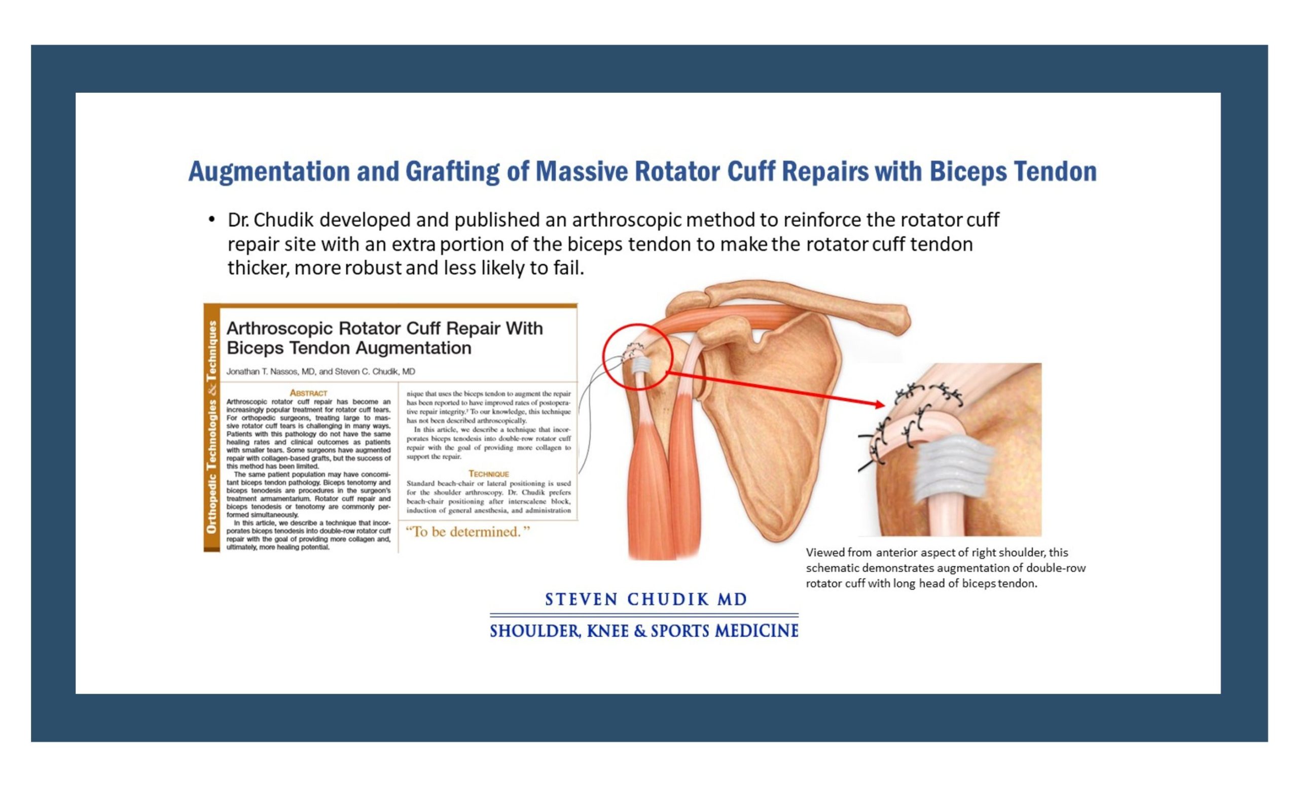 Shoulder Tendon Repair Special Procedure - Steven Chudik MD